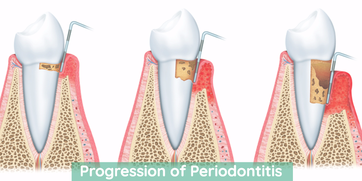 Diagram of periodontal disease