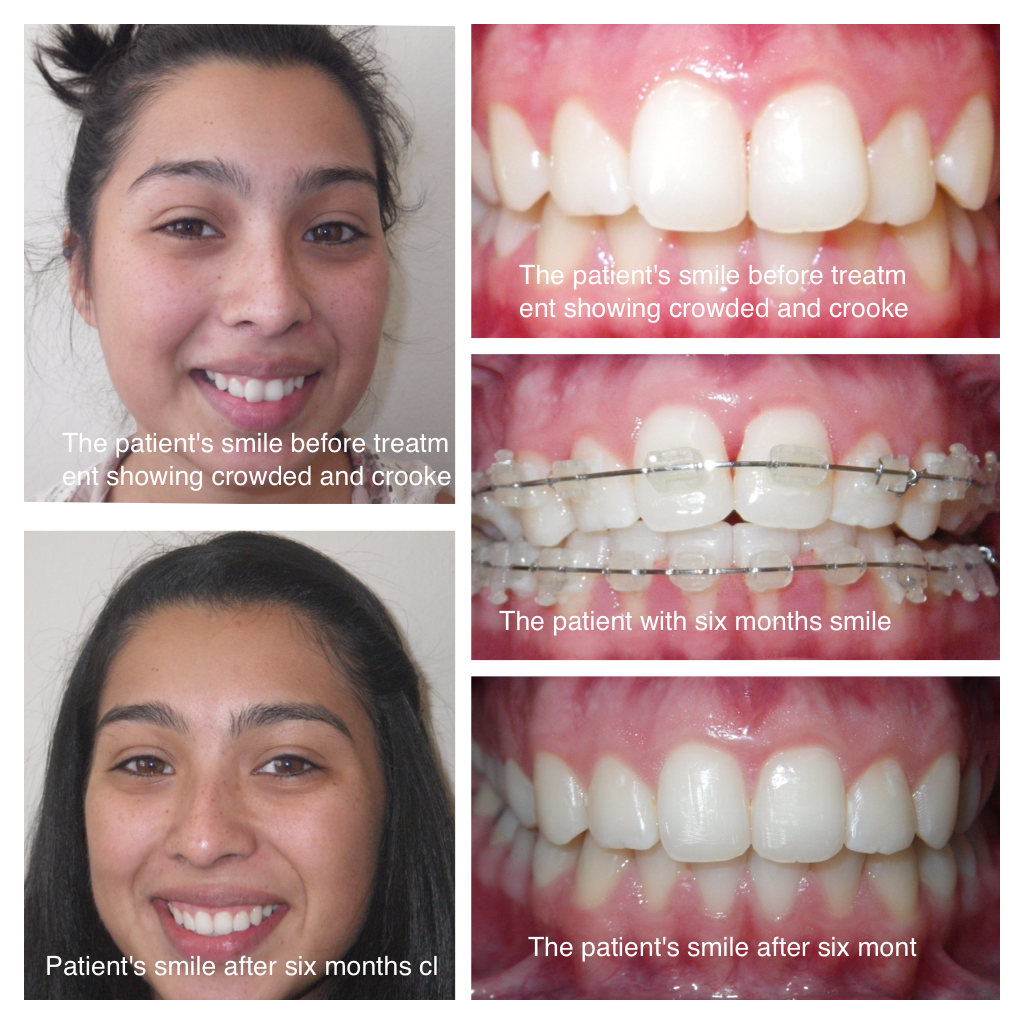 Teeth Alignment Techniques - LA Dental Clinic