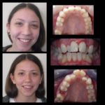 before/after invisalign