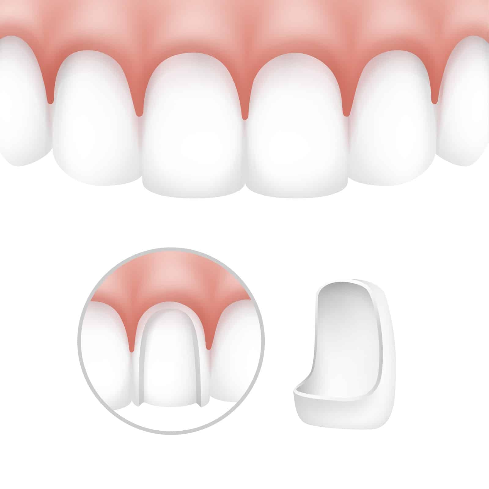 diagram of dental veneers