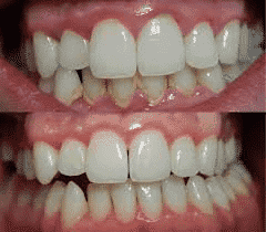 Receding gums due to gingivitis and periodontal disease causing pain and sensitivity