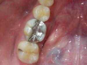 Cracked silver filling causing sensitivity and toothache