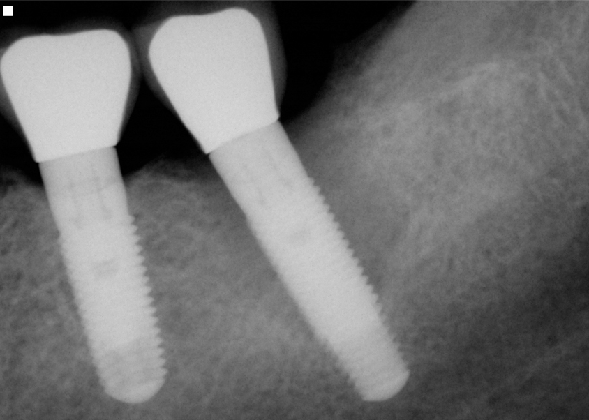 replace dental implant