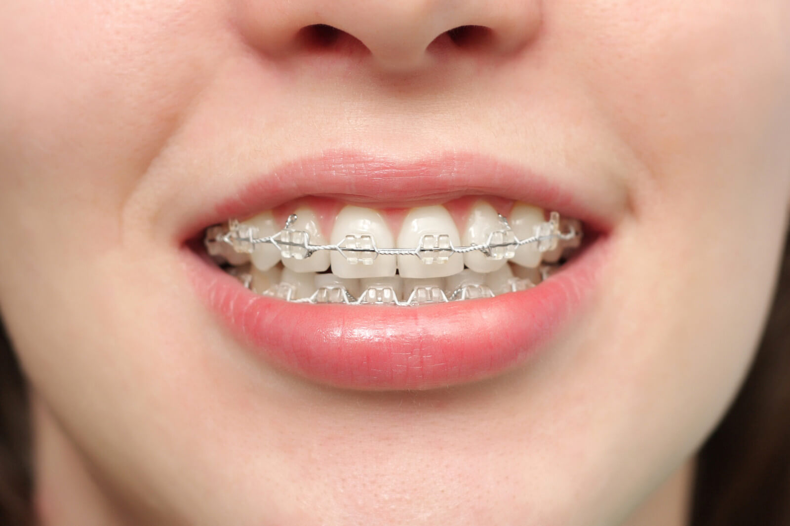 Cost of Dental Braces in Los Angeles, CA - Smile Angels of Beverly Hills