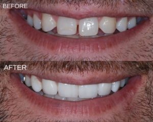 Dental-bonding-before-and-after