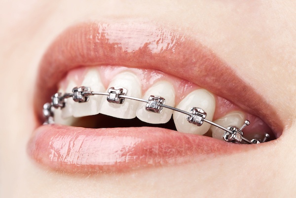 woman with braces in los angeles