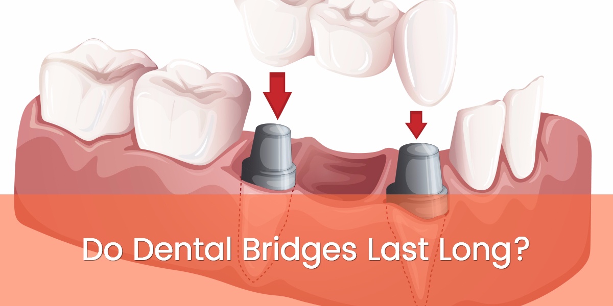 do-dental-bridges-last-long-la-dental-clinic