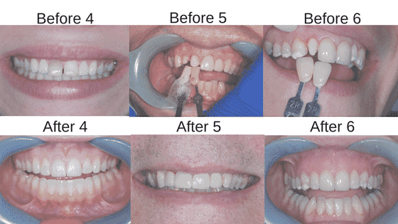 Teeth before and after crowns