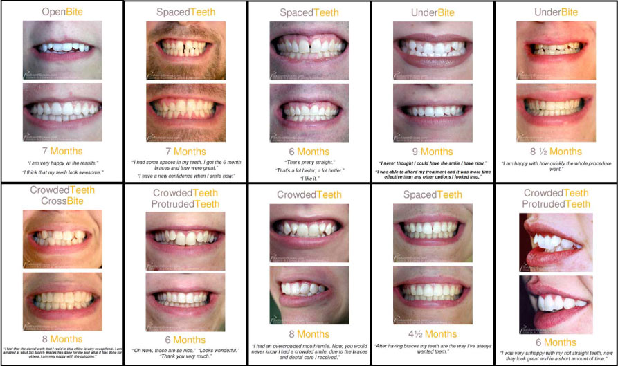 Orthodontics - Invisalign Before & After - Orthodontic therapy Ismile