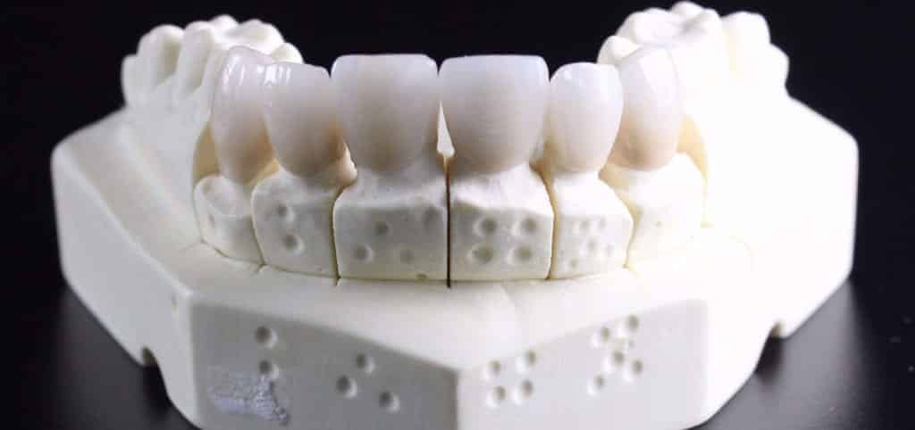 Broken Teeth Fix & Repair In Los Angeles, CA - LA Dental Clinic