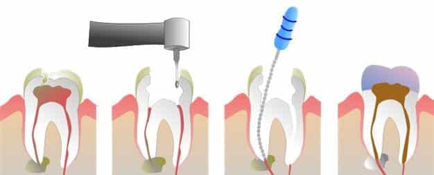 root canal infographic