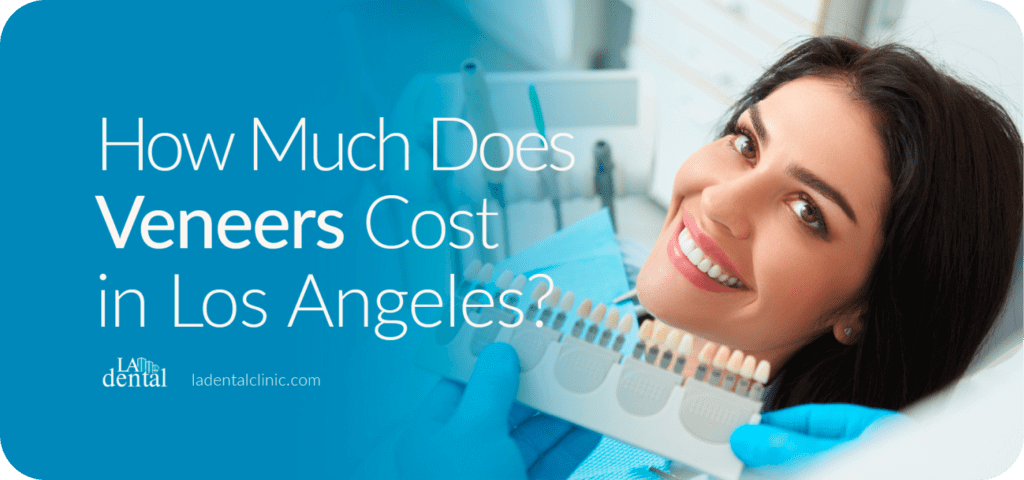how-much-does-veneers-cost