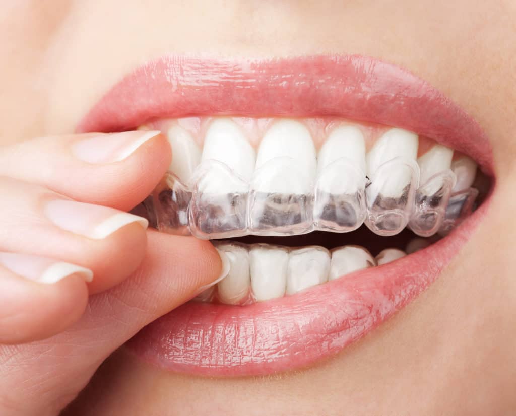 Braces vs Invisalign: Which Is Better