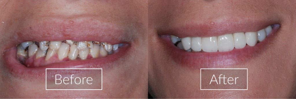 Before-&-After-Dental-Implant