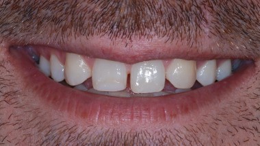 Composite and Porcelain Veneers in Los Angeles | LA Dental Clinic