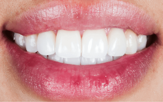discolored-smile-after-372x233_x1.5