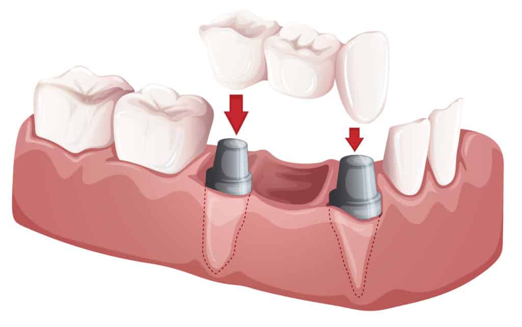 Dental bridge