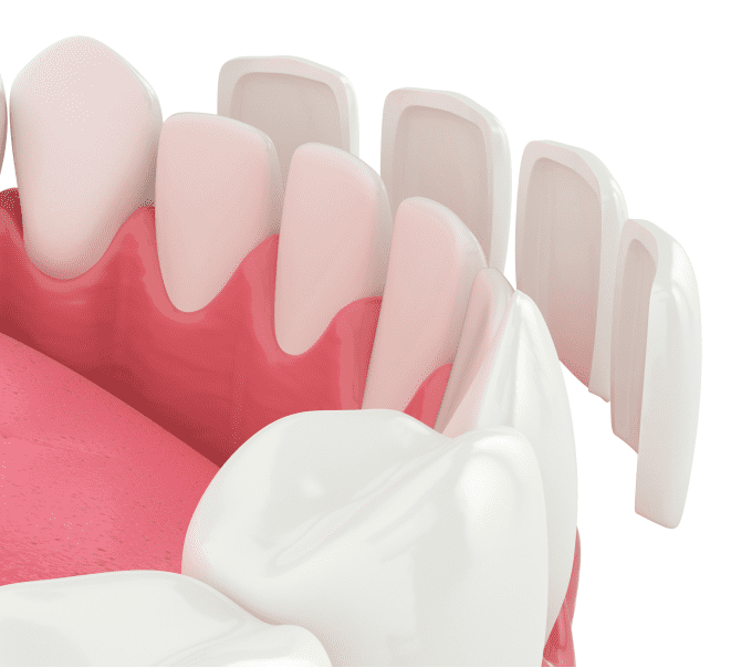 veneers-model-440x402_x1.5