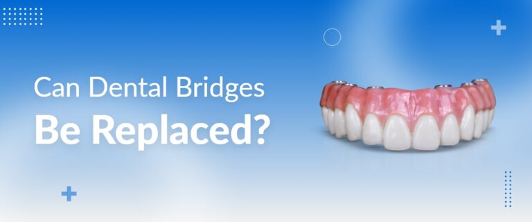 Can Dental Bridges Be Replaced?