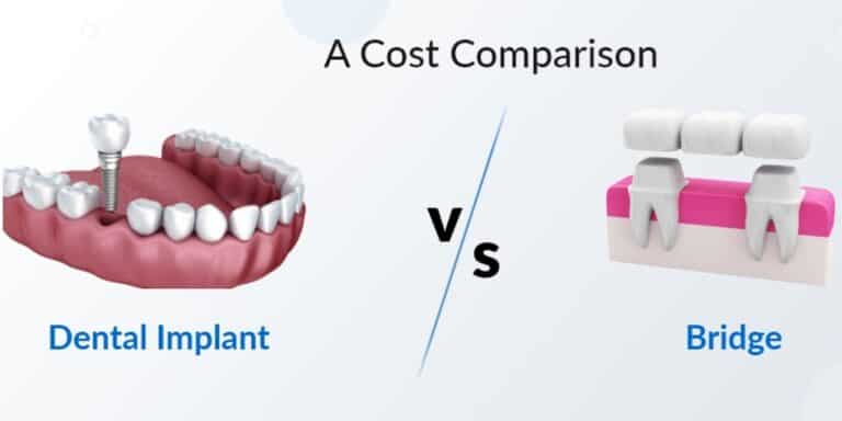 Dental Implant Vs. Bridge: A Cost Comparison