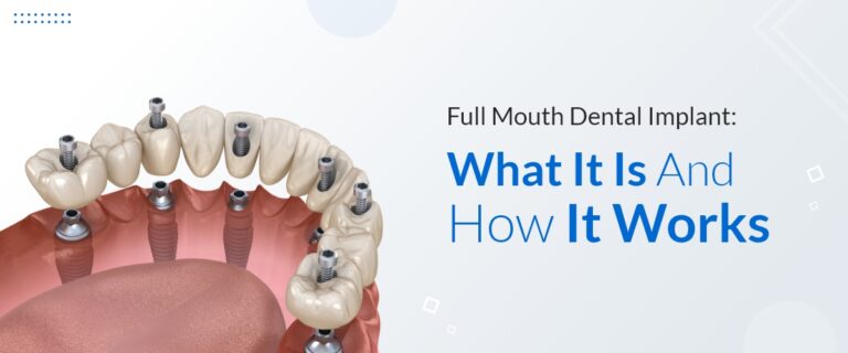 Full Mouth Dental Implant: What It Is And How It Works