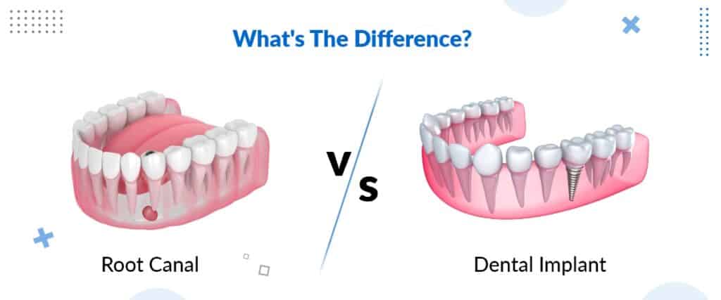 Root Canal Vs. Dental Implant: What’s The Difference?