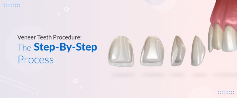 Veneer Teeth Procedure: The Step-By-Step Process