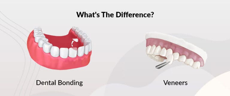 Dental Bonding Vs. Veneers: How To Decide Between Them