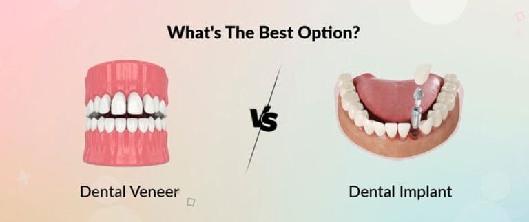 Dental Veneer Vs. Dental Implant: What's The Best Option?