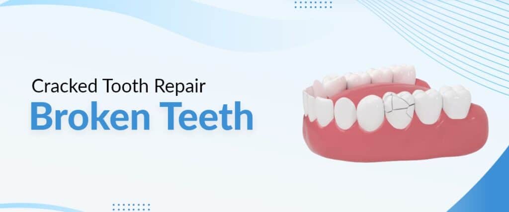 Broken Teeth Fix & Repair In Los Angeles, CA - LA Dental Clinic