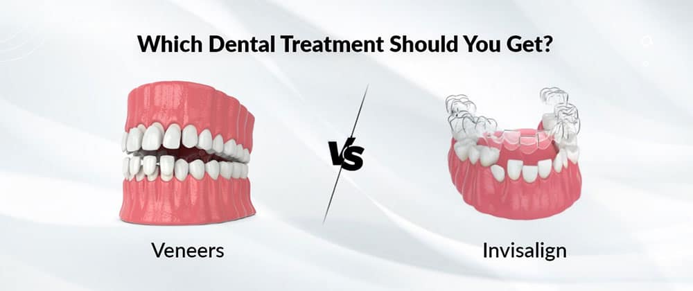 Veneers Vs. Invisalign: Which Dental Treatment Should You Get?