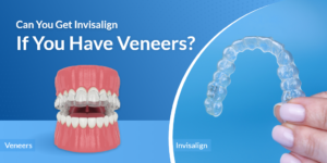 Can You Get Invisalign If You Have Veneers