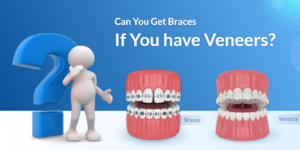 Can you get braces if you have veneers