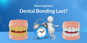 How Long Does Dental Bonding Last