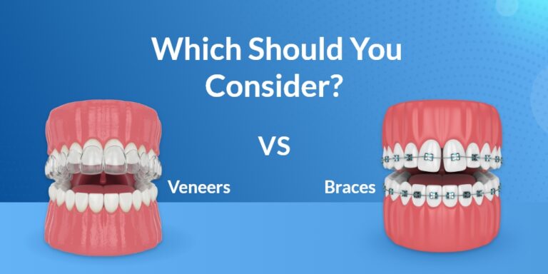 How OftenShould You CleanYour Invisalign – 1