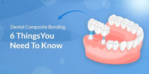 Dental Composite Bonding: 6 Things You Need To Know