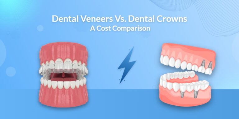 Dental Veneers Vs. Dental Crowns: A Cost Comparison