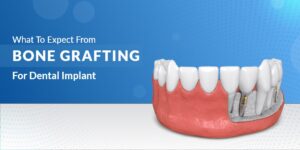 What To Expect From Bone Grafting For Dental Implant