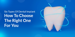 Six Types Of Dental Implants: How To Choose The Right One For You