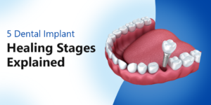5 Dental Implant Healing Stages Explained