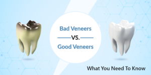 Bad Veneers Vs. Good Veneers: What You Need To Know