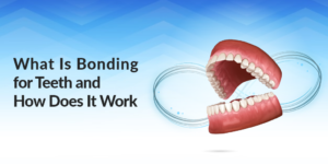 What Is Bonding For Teeth And How Does It Work?
