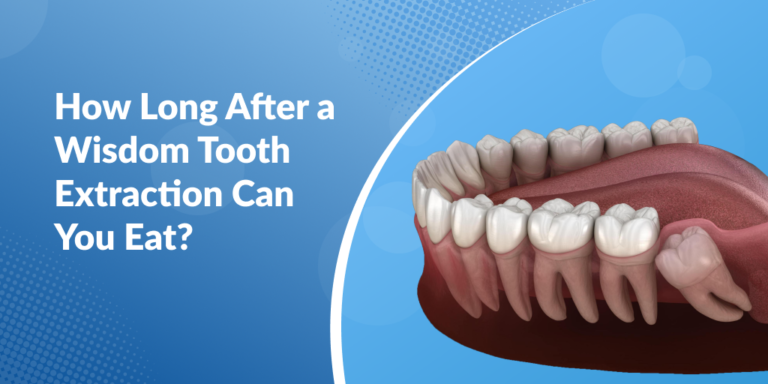 How Long After a Wisdom Tooth Extraction Can You Eat?