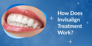 How Does Invisalign Treatment Work?