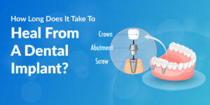How Long Does It Take To Heal From A Dental Implant?