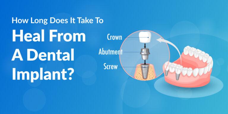 How Long Does It Take To Heal From A Dental Implant?