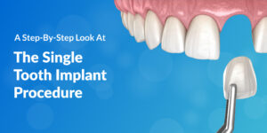 A Step-By-Step Look At The Single Tooth Implant Procedure