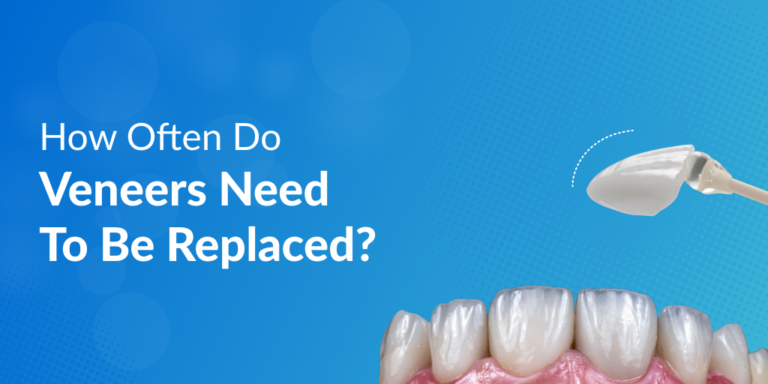 How Often Do Veneers Need To Be Replaced