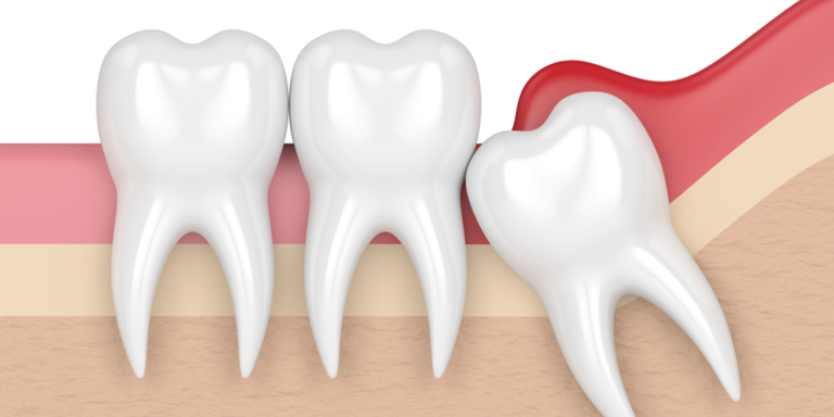 Can Wisdom Teeth Grow Back After They’ve Been Removed?