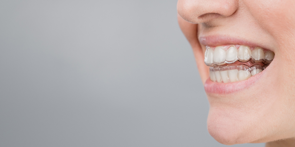 What Should You Do When Your Invisalign Is Not Tracking?